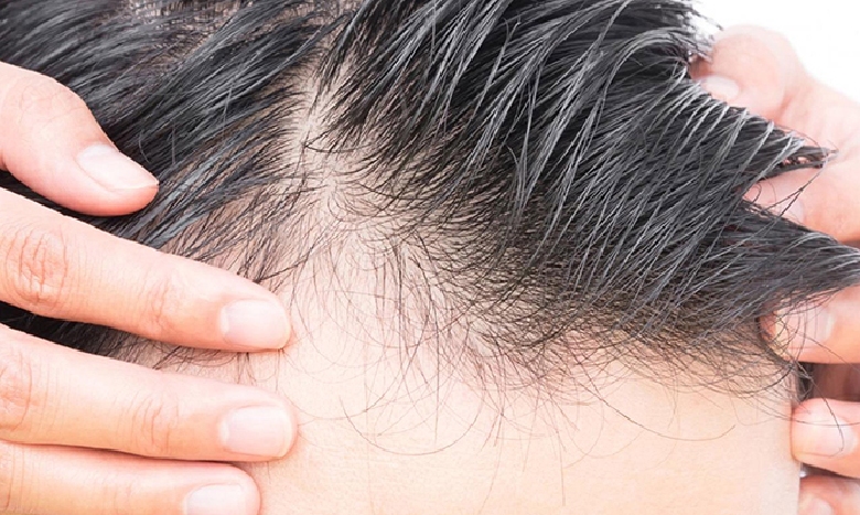 علت ریزش مو در مردان